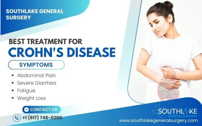 Best Treatment for Crohn's Disease: Expert Options - Southlake General ... Best Treatment for Crohn's Disease: Expert Options - Southlake General ...
