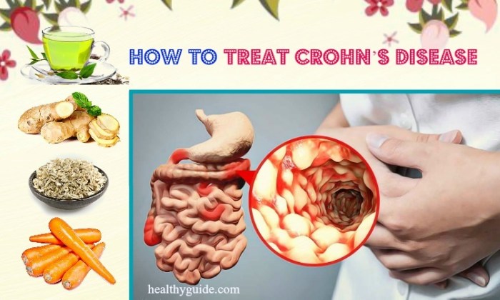 Is there any natural treatment for Crohn's disease? Is there any natural treatment for Crohn's disease?
